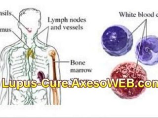 Tải video: Lupus-Breakthrough ☺ Cure Lupus Step by Step