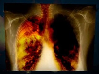 Asbestos Removal Palm Beach Gardens 561 FL