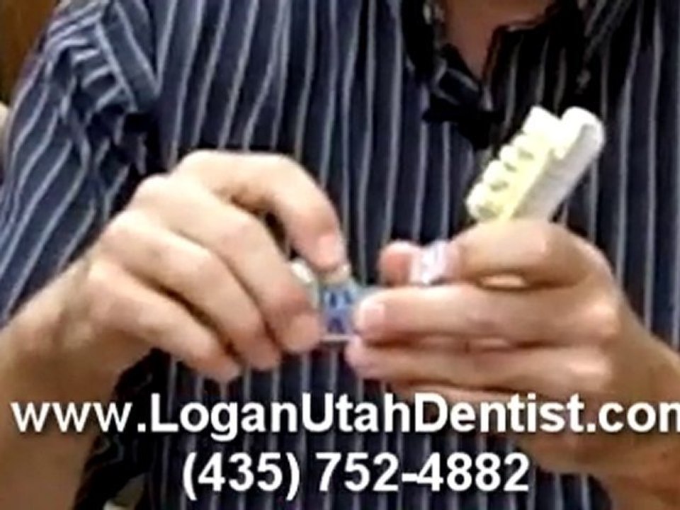 Logan Utah Dentist - Dental Crowns