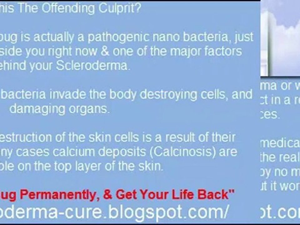 Scleroderma Treatment - The Secret To Beating Scleroderma