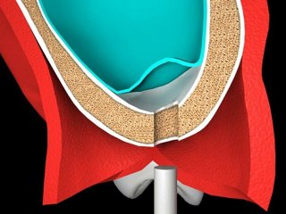 Mr.Curette Co's Diamond Sinus Expander