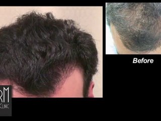 Hair Transplant Repair-The Emotional Journey of A Patient
