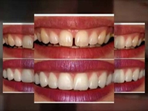Beverly Hills, Ca Porcelain Veneers (866) 380-0023