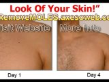 IMPORTANT How Vanish your moles? Discover How Vanish Moles !