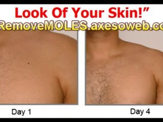 Vanish Your Skin Tags in 3 days Nat from home Start today!