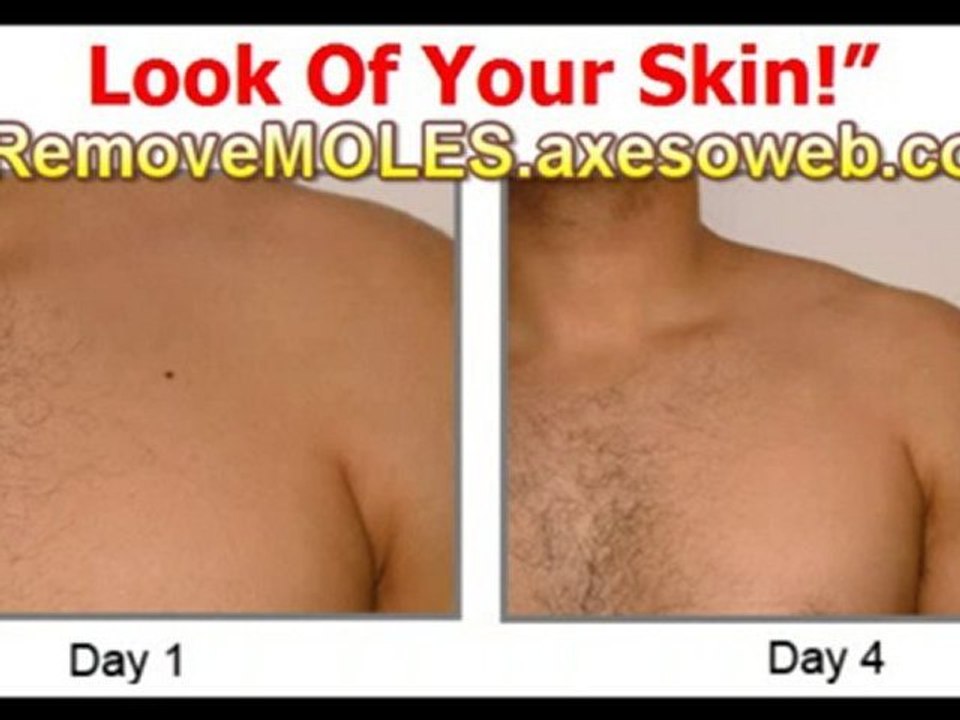 Destroy Your Warts in Just 3 Days - Ass Seen on TV ® Best !