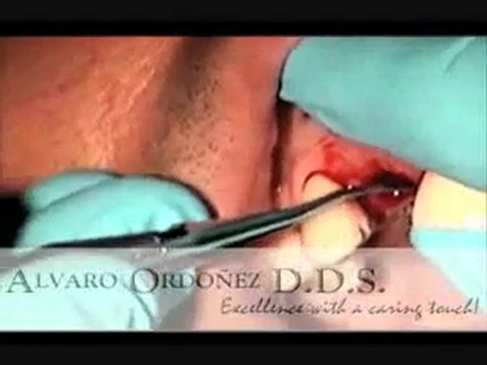 İmmediate implant yerleştirme.flv