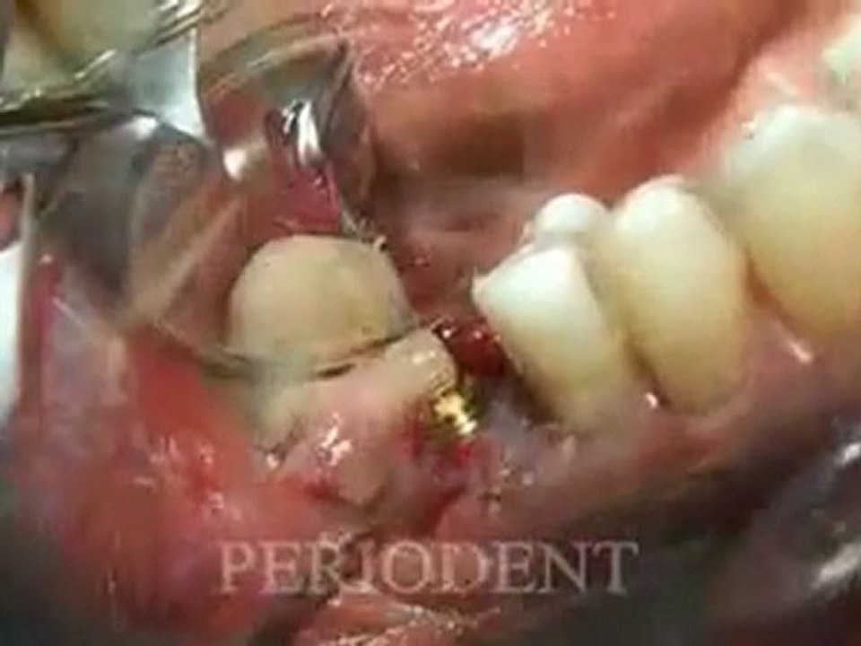 İmmediate implant yerleştirme 2.flv