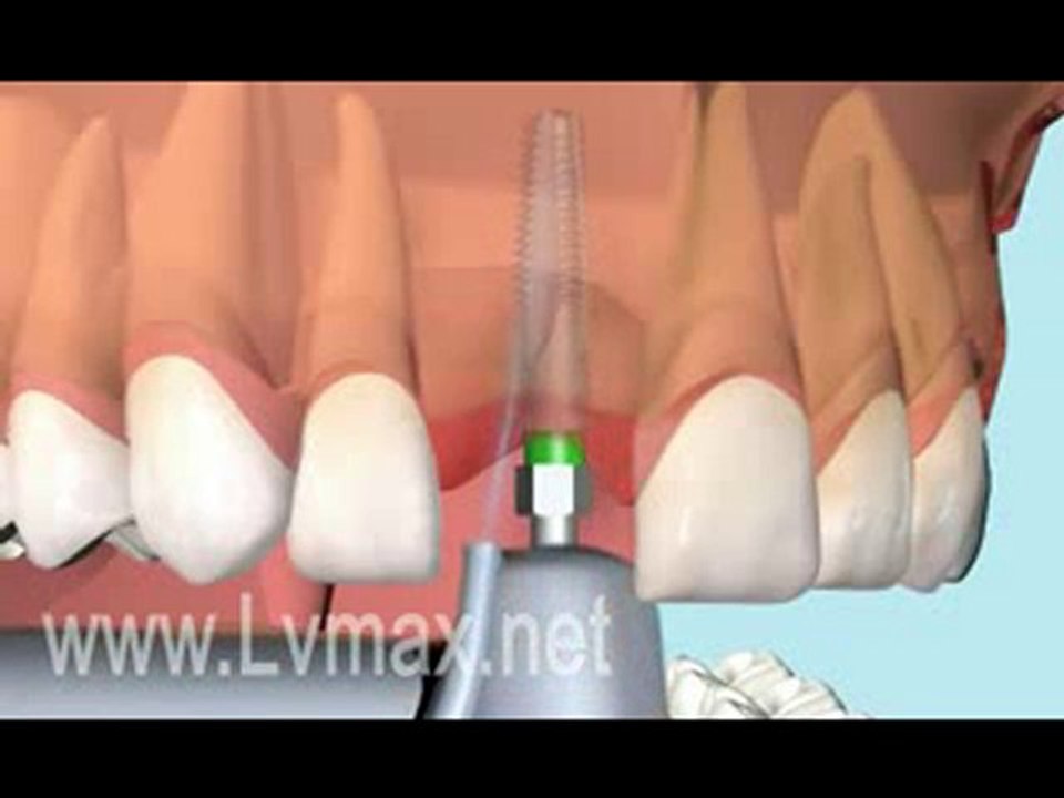 İmplant yerleştirme animasyon.flv