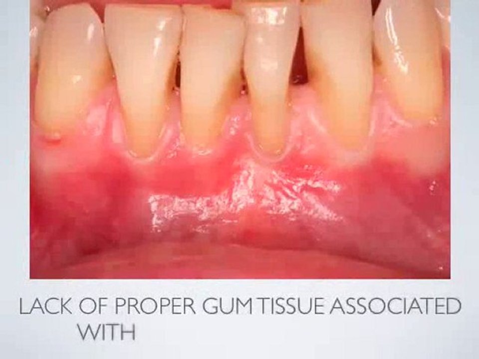 periodontal plastik cerrahi sizin için neler yapabilir.flv