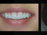 Dentist Woodland Hills Free Teeth Whitening