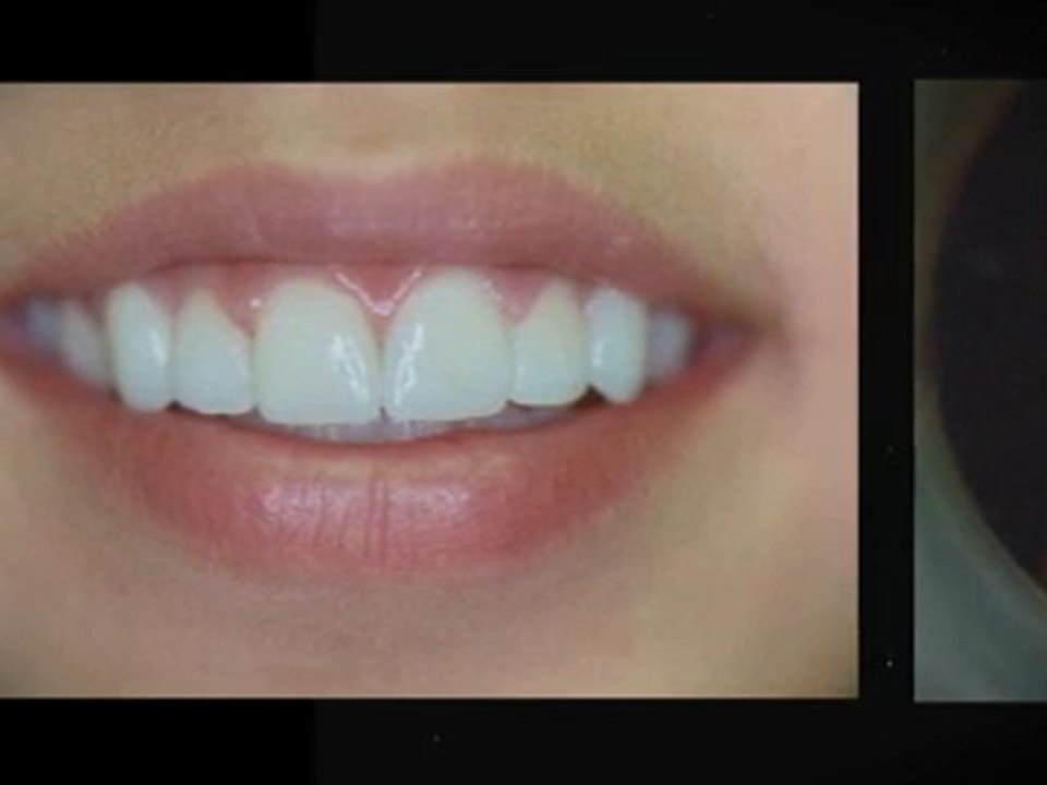 Dentist Woodland Hills Free Teeth Whitening