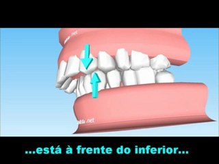 Classe I, Classe II e Classe III