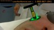 Facial Hair Removal by Laser – 800-867-1941