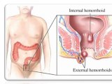 Como Curar las Hemorroides - Hemorroides Tratamiento