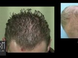 Level 3  baldness hair restoration with 3500 FUE grafts