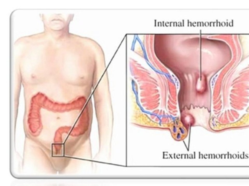 Como Curar las Hemorroides - Hemorroides Tratamiento