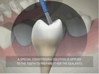 Sterling-Heights-Zoom-Whitening-Center-sealants