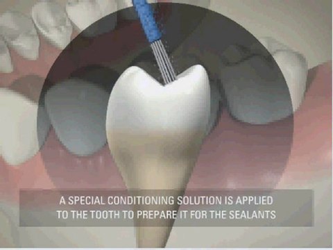 Sterling-Heights-Zoom-Whitening-Center-sealants