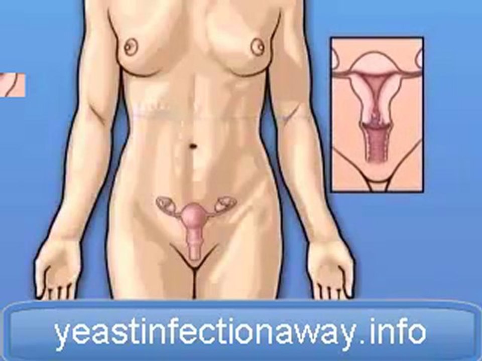 myomectomy vaginal fibroid cure ...