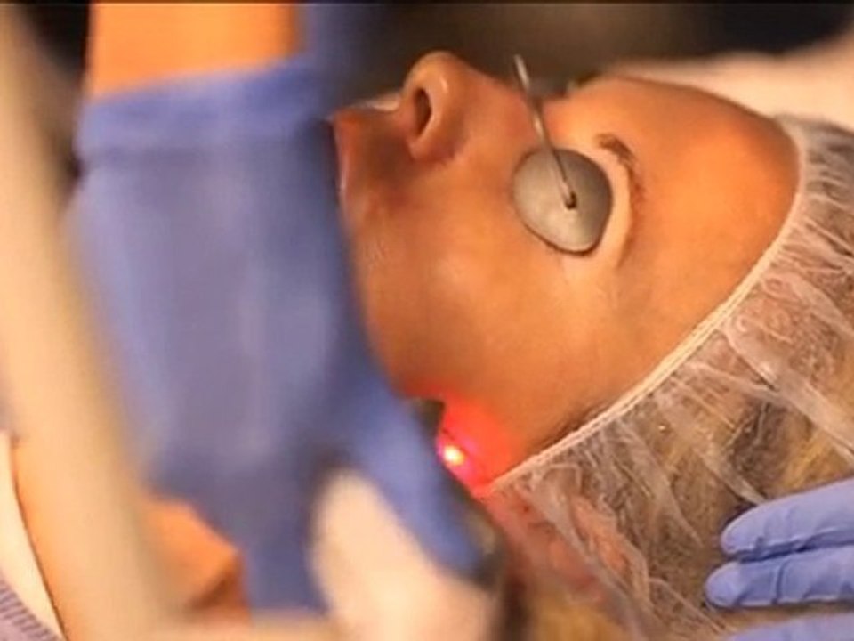 CO2 Laser Skin Resurfacing Tampa Bay – Vein & Cosmetic Ctr.