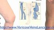 Find Varicose Veins Treatment Removal Surgery in Lancaster,