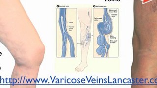 Find Varicose Veins Treatment Removal Surgery in Lancaster,