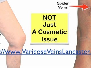 Spider, Varicose Vein Trearment Lancaster, Varicose Vein Re