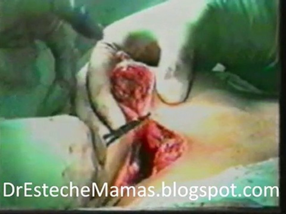Mamoplastia de reduccion para tener senos pequeños
