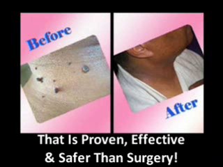 Proven & Tested Herbal Mole Removal Cream
