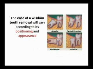 Wisdom Teeth Tips in Crystal Lake