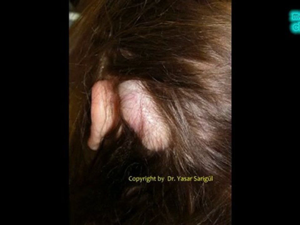 dr. yasar sarigül - Lipom beule am kopf zyste am kopf
