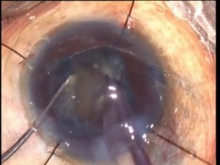 Small Pupil Phaco  -  Dr.NSD Raju, India