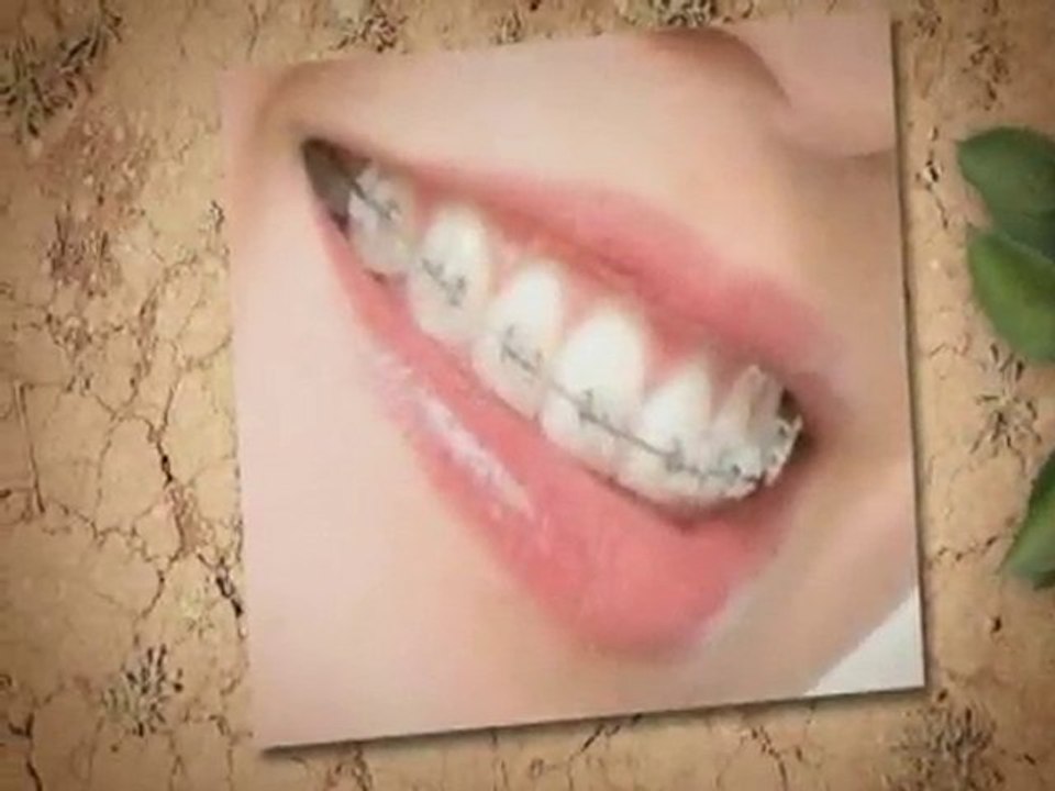 Dentists Harrisonburg Va:Do I Need Braces
