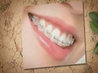Dentists Harrisonburg Va:Do I Need Braces