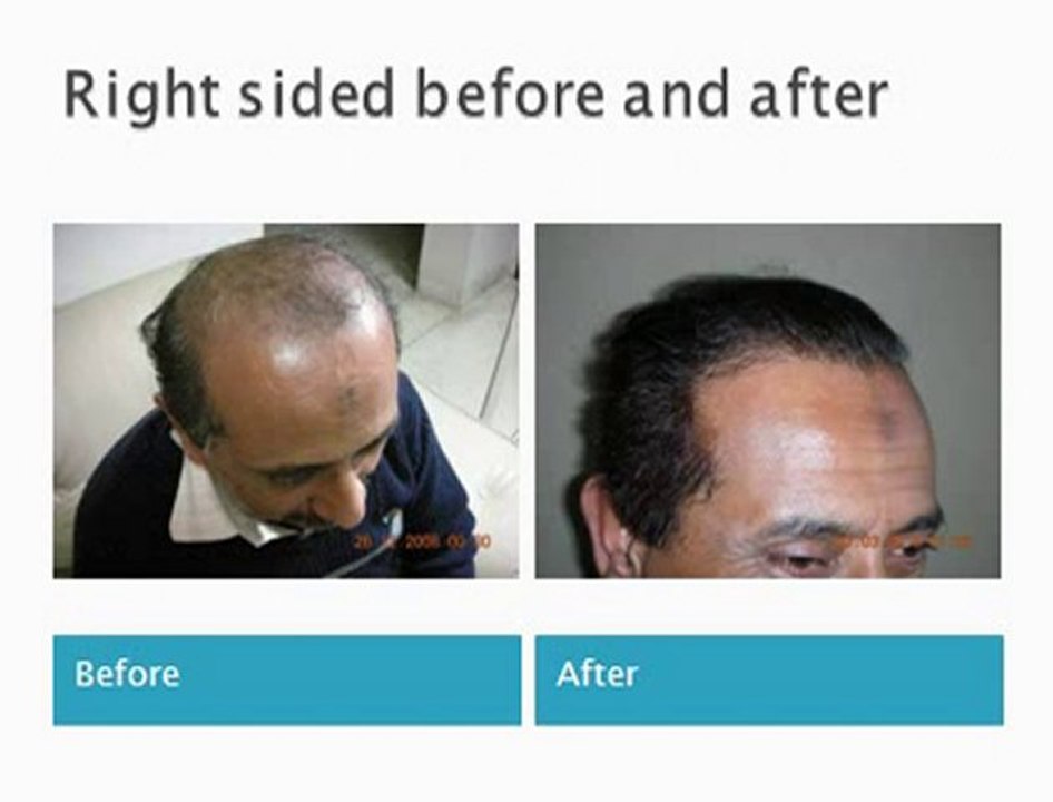 Hair Transplant in Pakistan