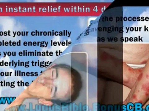 Lupus Bible - Lupus Early Symptoms