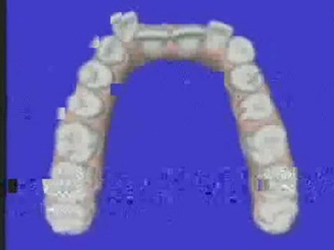 Alpharetta Invisalign Invisaline Braces Align Teeth, Fix Sm
