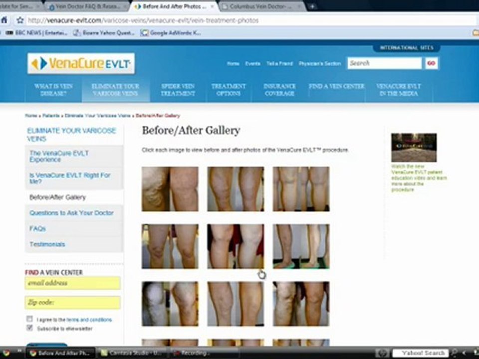Varicose Vein Doctor Consultations and Information
