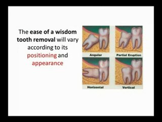 Wisdom Teeth Tips in Crystal Lake
