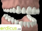 Dental patient education - Connective tissue graft