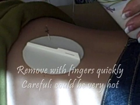 San Deigo Acupuncture Warming Needle Moxa Demonstration