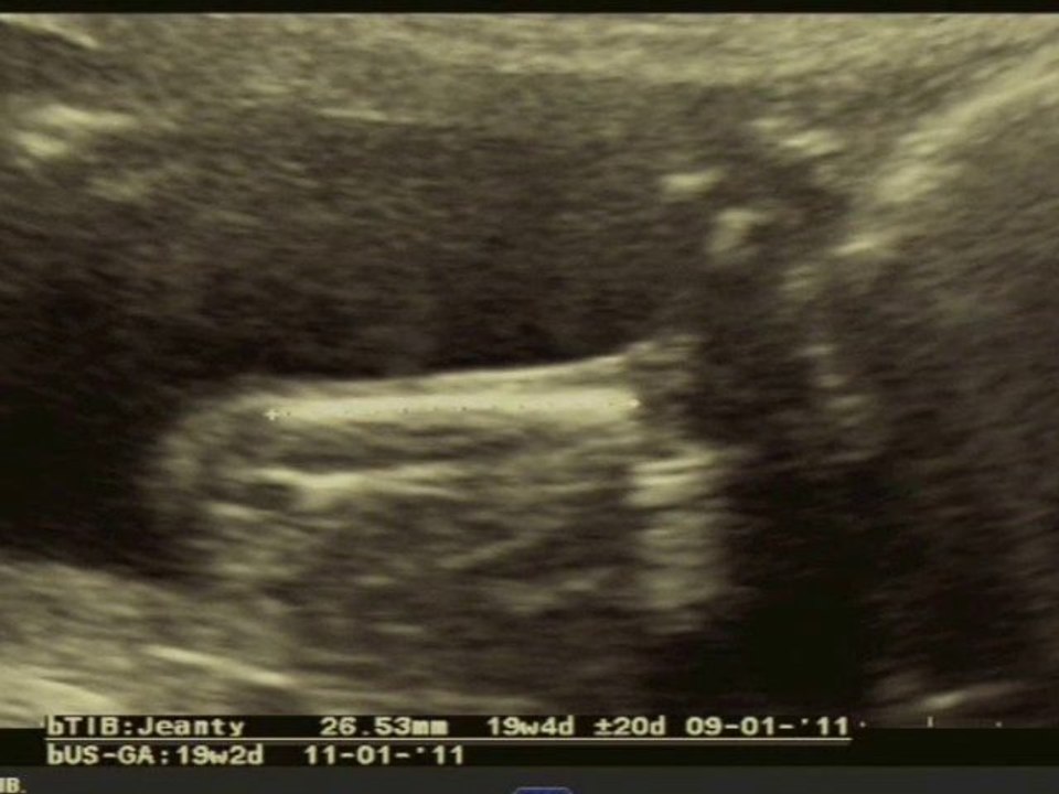acondroplasia