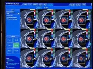 What is Cyberknife VSI Radiosurgery Cancerous Tumor Treatme