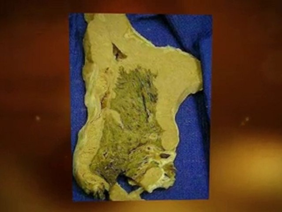 Asbestos Mold Problem  Bradenton FL