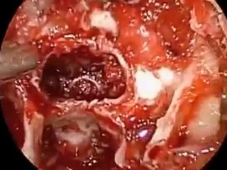 Dr Marc Eisenberg et Dr Todd Schaeffer et la Tumeur pituit