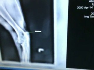 eFilm Part II - digital radiography training - Ron Chavers