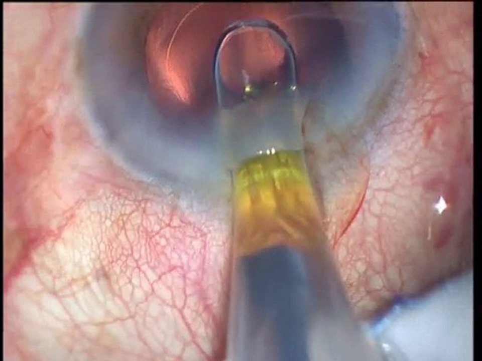 IQ IOL implantation following phaco chop -Dr.NSD Raju, India