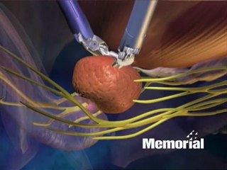 Prostate Cancer Treatment Memorial Hospital Gulfport, MS