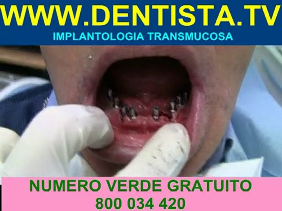 IMPLANTOLOGIA TRANSMUCOSA DENTISTA.TV
